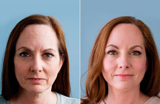 Before/After Kállay Amália