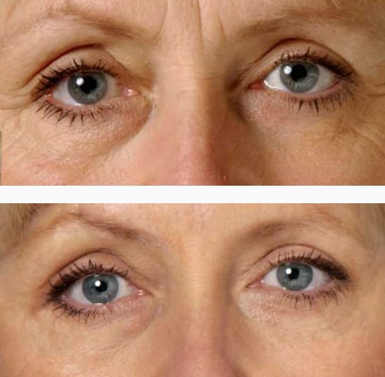 Before/After Kállay Amália